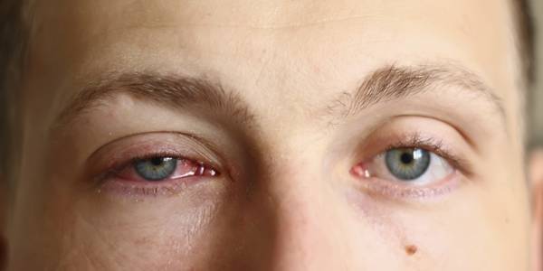 قطرة عين بيفن Bephen لعلاج هربس العينين