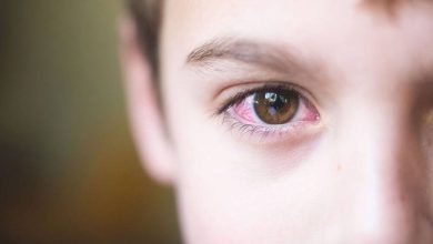علاج حساسية العين واحمرارها في المنزل