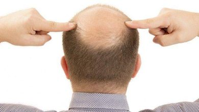 سبب تساقط الشعر عند الرجال
