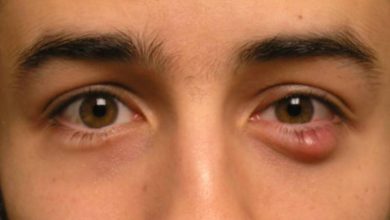 علاج الكيس الدهني في العين بالثوم