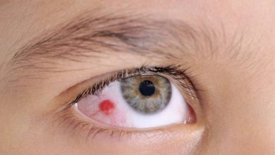 ما الذي يسبب بقعة حمراء في العين